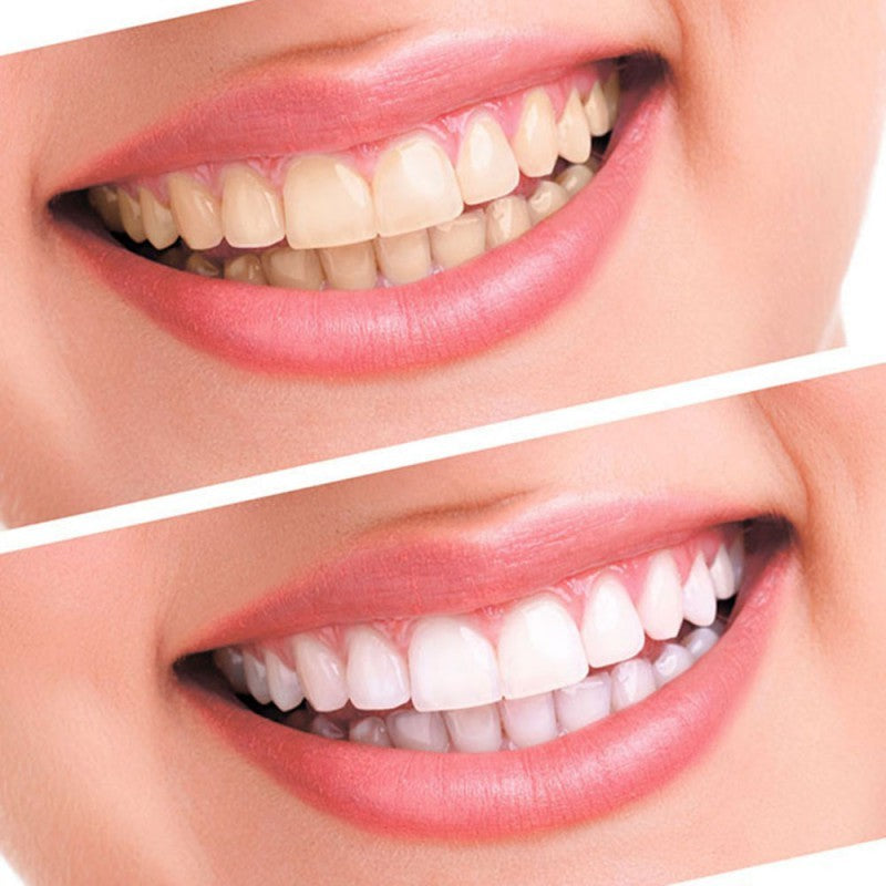 Teeth Whitening Oral Kit